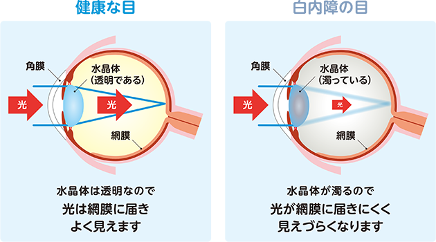健康な目と白内障の目