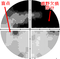 中期緑内障の視野
